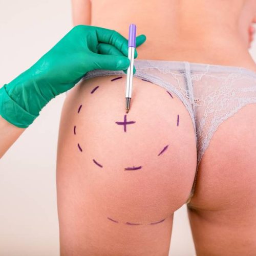 Surgeon drawing marks on female body before plastic operation, white background. Liposuction concept